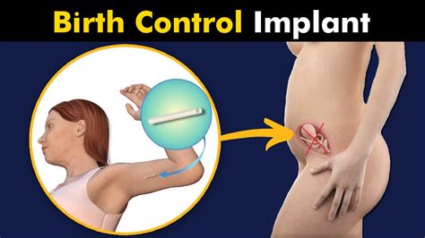 Birth control Progestin Implant / Contraceptive implant - YouTube