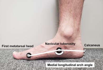 Effect of Arch Height Flexibility in Individuals With Flatfoot on Abductor Hallucis Muscle ...