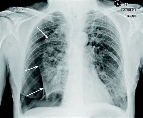 Spontaneous pneumothorax | The BMJ