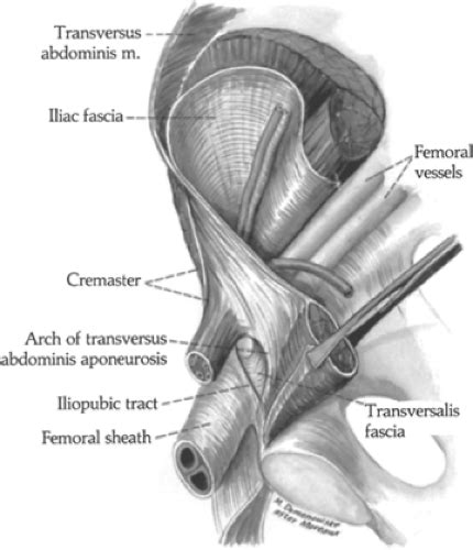 Iliopubic Tract Vs Inguinal Ligament