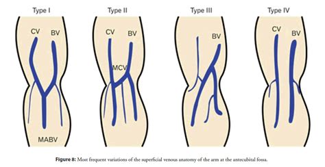 Distal cephalic vein access for right heart catheterization from