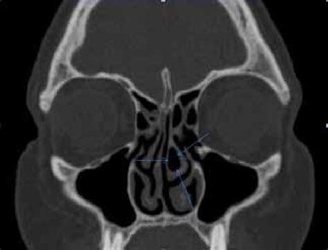 Concha bullosa on the left middle turbinate | Download Scientific Diagram