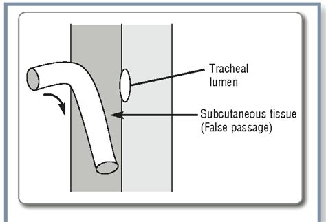 Figure 3 from Tracheostomy care and complications in the intensive care ...