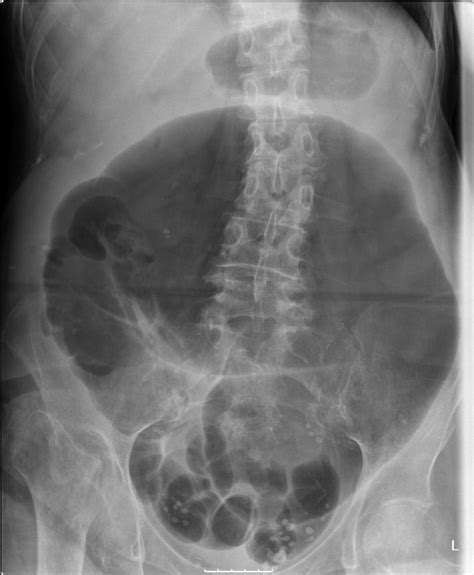 Volvulus. Causes, symptoms, treatment Volvulus