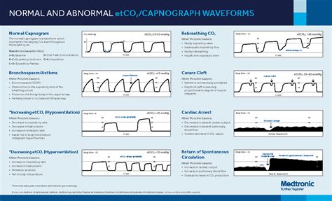 Capnography normal and abnormal waveforms poster - Waveform ...