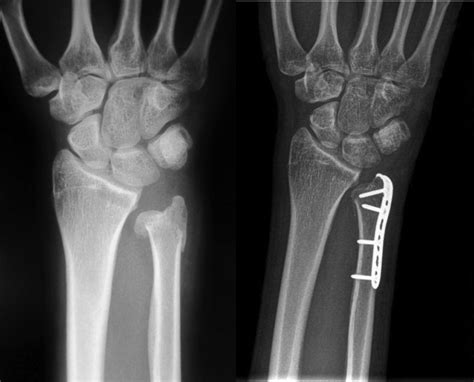 Distal Ulna Fractures - Journal of Hand Surgery