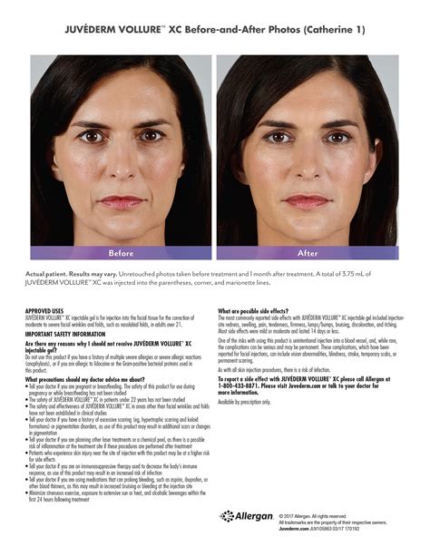 Juvederm Vollure Facial Filler | SOMA Skin & Laser