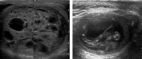 Testicular Teratoma Ultrasound