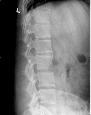 Ankylosing spondylitis cervical spine x ray - questgang