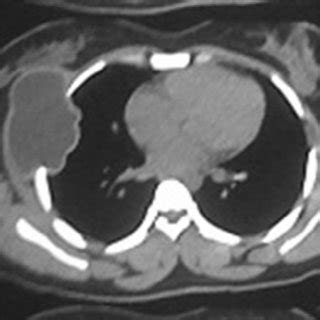 (PDF) Primary malignant chest wall tumors: Analysis of 40 patients