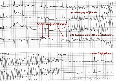 ECG Rhythms: ECG characteristics of Torsades de Pointes (TdP)