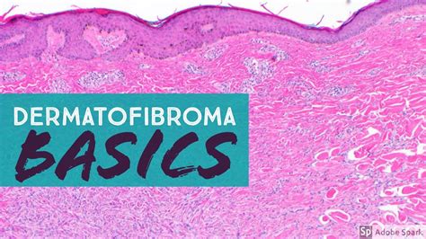 Dermatofibroma Histology