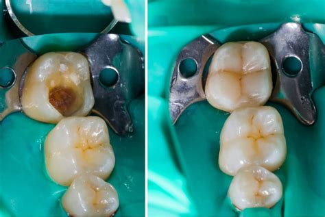 Tooth Cavity Before And After