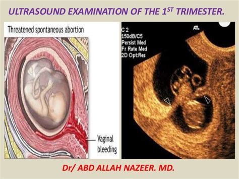 Presentation1.pptx, ultrasound examination of the 1st trimester pregn…