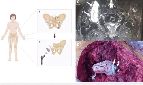 Reconstruction of hemipelvectomy I-II. (A) The right pelvis ...