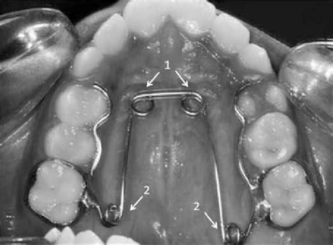 Quad-helix expander | Download Scientific Diagram