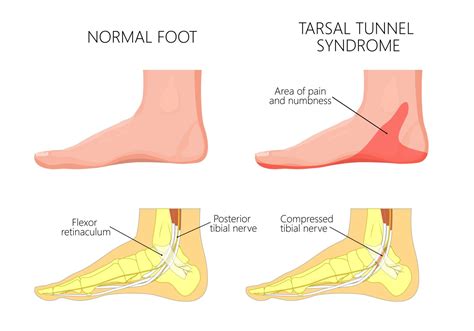 Common Questions after Tarsal Tunnel Surgery | Dr. Eric H. Williams