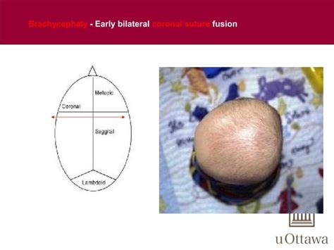 Craniofacial anomalies | PPT