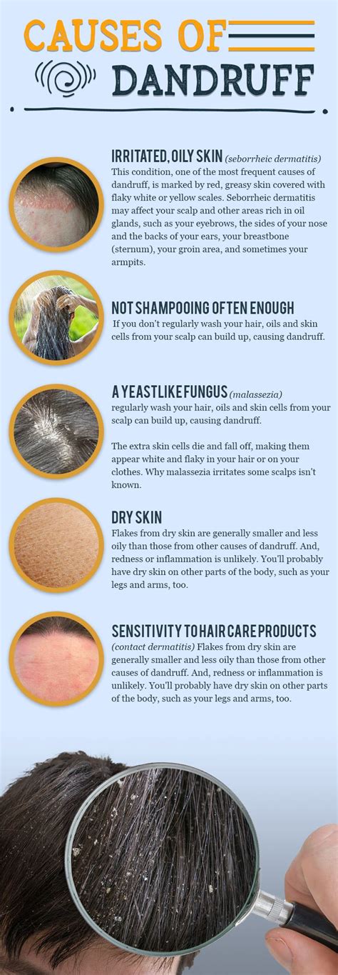 Discover what the causes of dandruff are. #HealthyBeauty #Causesof Dandruff | Dandruff, Healthy ...