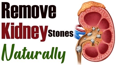 Remove Kidney Stones Naturally with Karma Ayurveda | Karma Ayurveda Hospital - YouTube