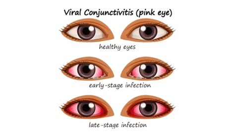 Conjunctivitis: Causes, how this viral eye infection spreads, treatment ...