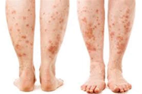 Scurvy Disease (Psoriasis)