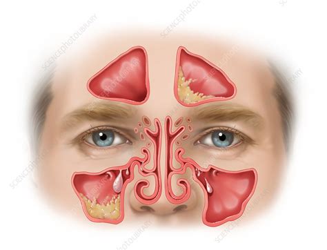 Nasal Polyps Sinus Infection