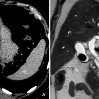 (PDF) Pylephlebitis: A Systematic Review on Etiology, Diagnosis, and Treatment of Infective ...