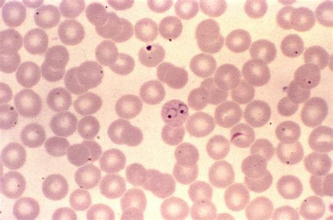 Plasmodium Ring Forms