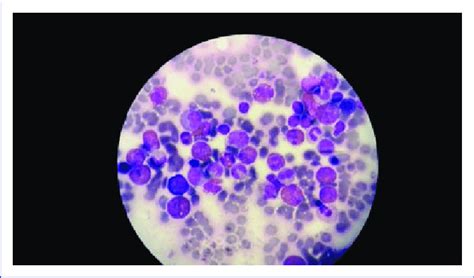 Hypocellular bone marrow with significant eosinophilia of the... | Download Scientific Diagram