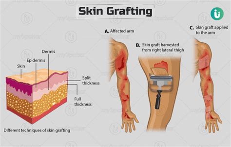 Skin grafting: Procedure, Purpose, Results, Cost, Price