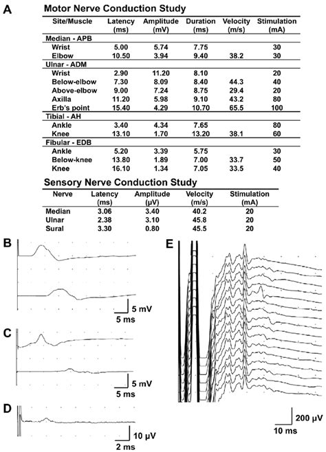 Figure1.Nerve conduction study findings. A: Nerve conduction studies ...