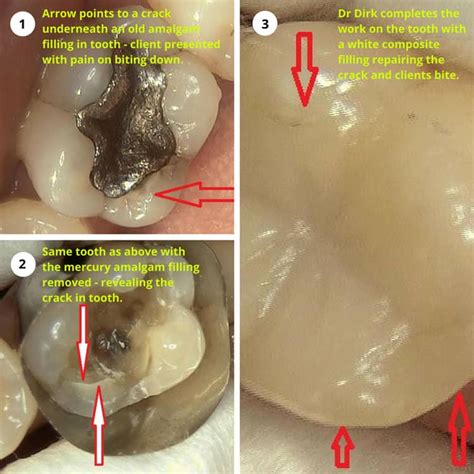 Mercury amalgam fillings and the cracked tooth connection | Dental Pod ...