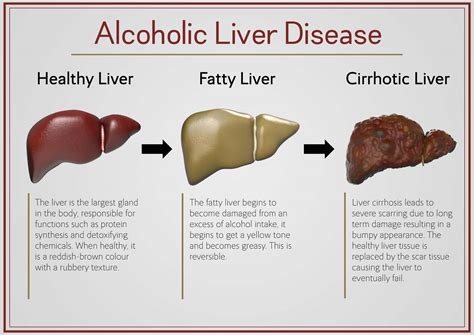 Alcoholic Liver Disease - Liz Paton Medical Art