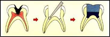 Baby Root Canal – ParkAveSmile, Perfect Dental Clinic