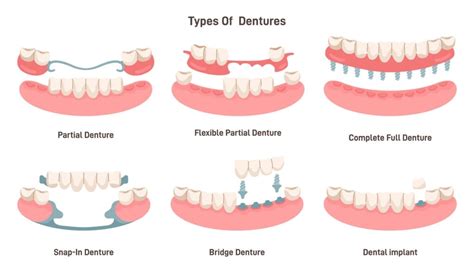 All About Dentures: A Comprehensive Guide