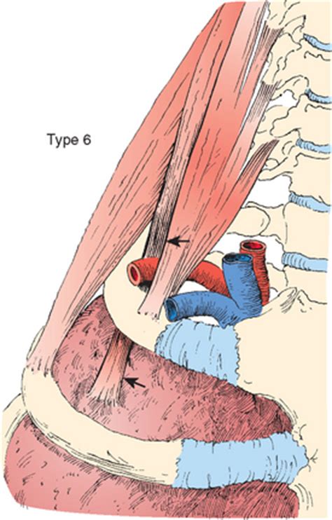 Congenital Anomalies and Variational Anatomy of the Shoulder | Musculoskeletal Key