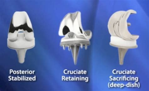 Posterior Stabilized Total Knee | Orthoped