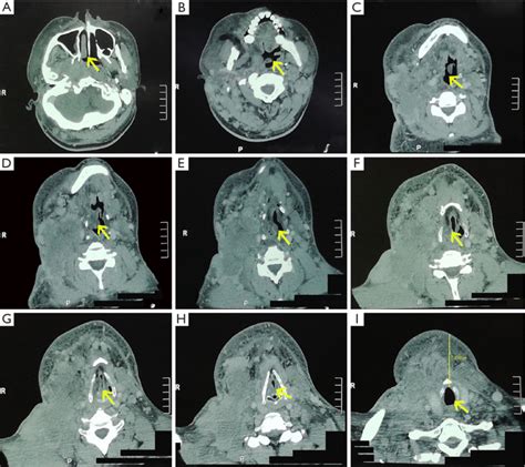 Typical neck CT images and a detailed analysis of the causes of the ...