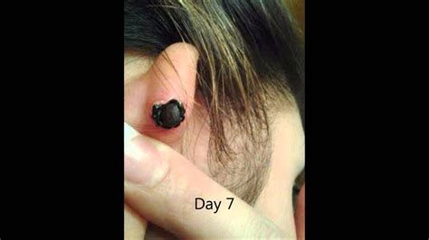 keloid removal (with rubberband) - YouTube