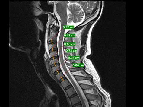 Ligamentum Flavum Cervical Spine