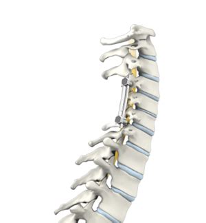 Posterior Cervical Fusion Milwaukee, Madison, WI | Cervical Fracture ...