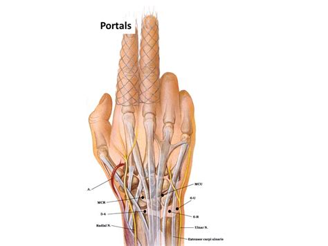 Wrist Arthroscopy