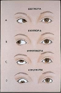 Strabismus - Dr. Vryghem