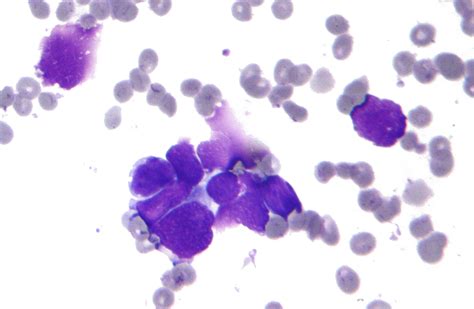 File:Small cell lung cancer - cytology.jpg - Wikipedia