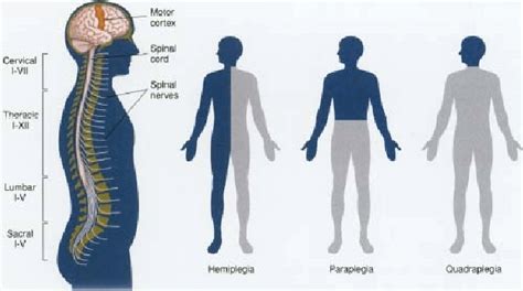 Types of paralysis [4] | Download Scientific Diagram