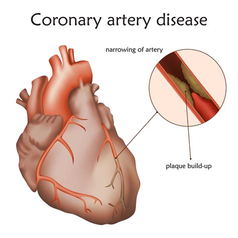 Coronary Artery Disease - Lathrup Village, MI: Heart and Vein Center