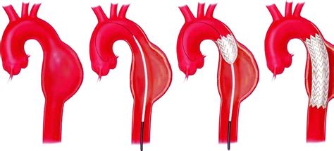 Aortic Aneurysms: Defusing the Ticking Time Bomb - Gregory Koshkarian, MD, FACC