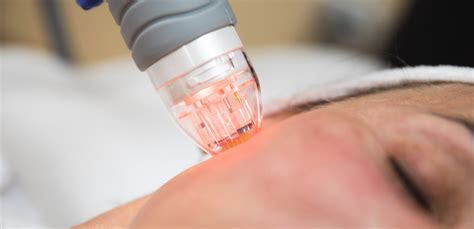 Scarlet RF Microneedling - Advanced Dermatology Care