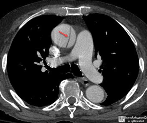 Aortic dissection과 혼동하는 CT 허상 (aortic pseudo-dissection) : 네이버 블로그